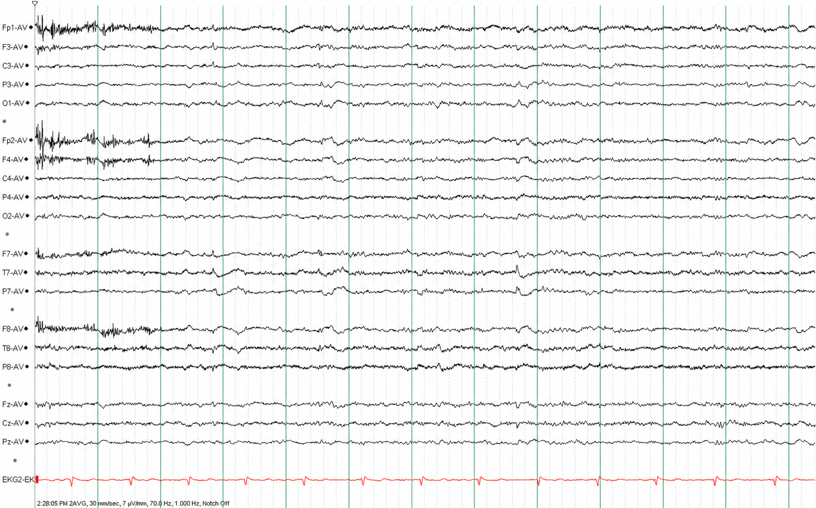 Small sharp spikes annotations off