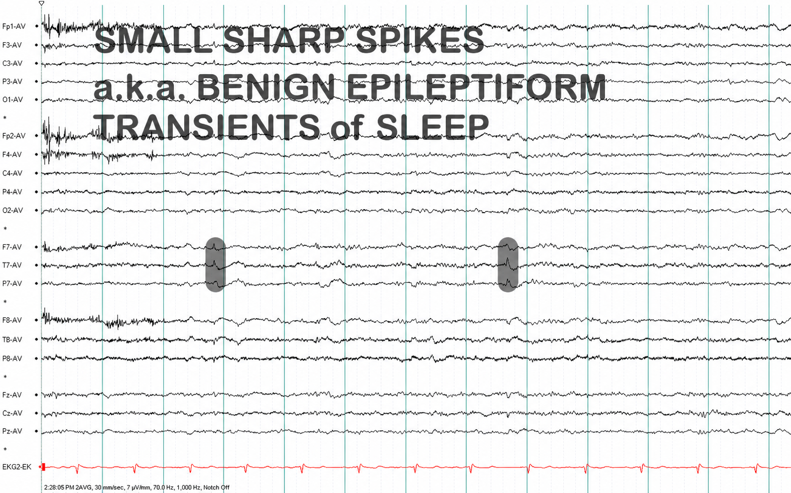Small sharp spikes annotations on