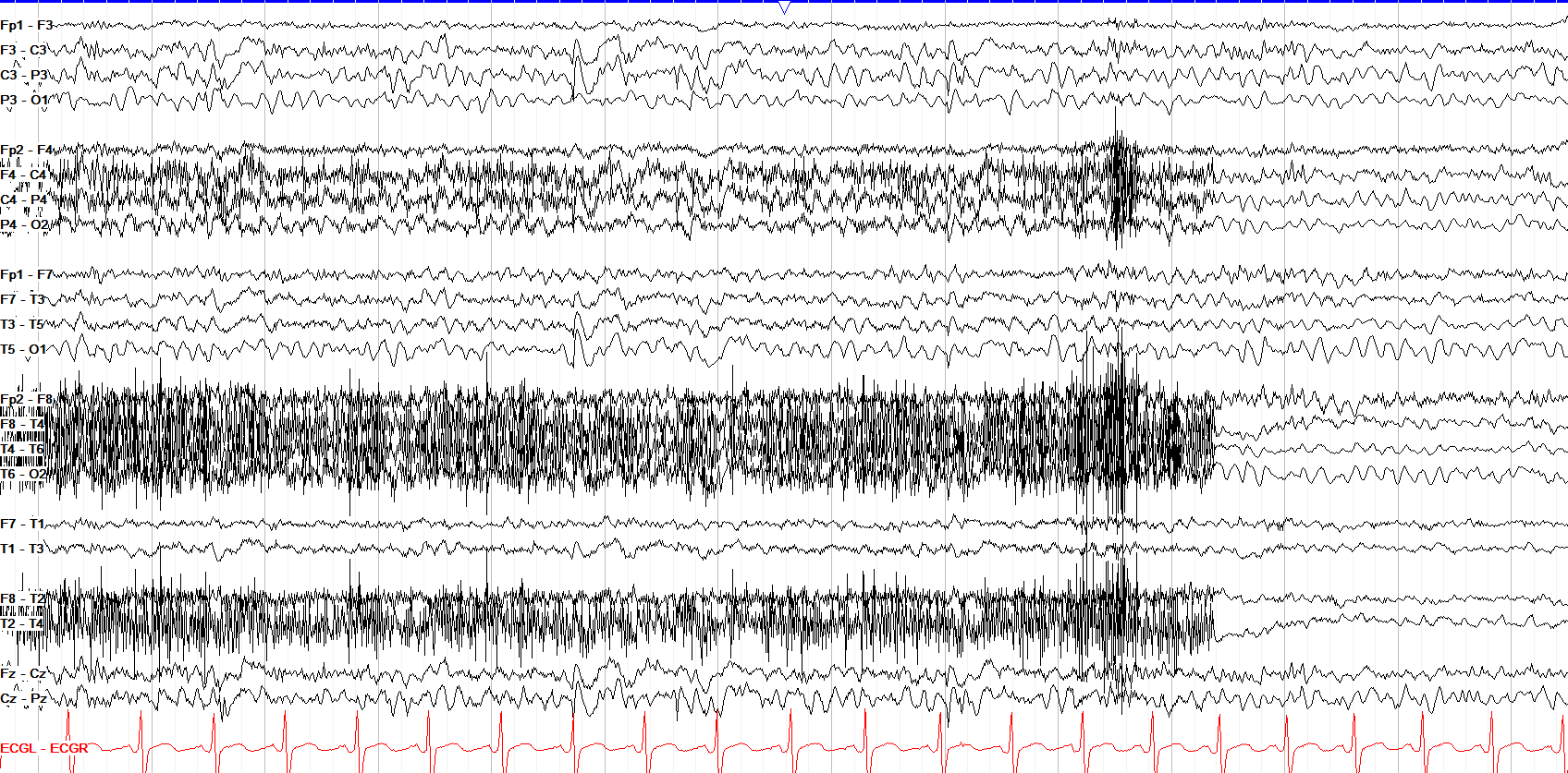 Bilateral centroparietal spike and wave annotations off