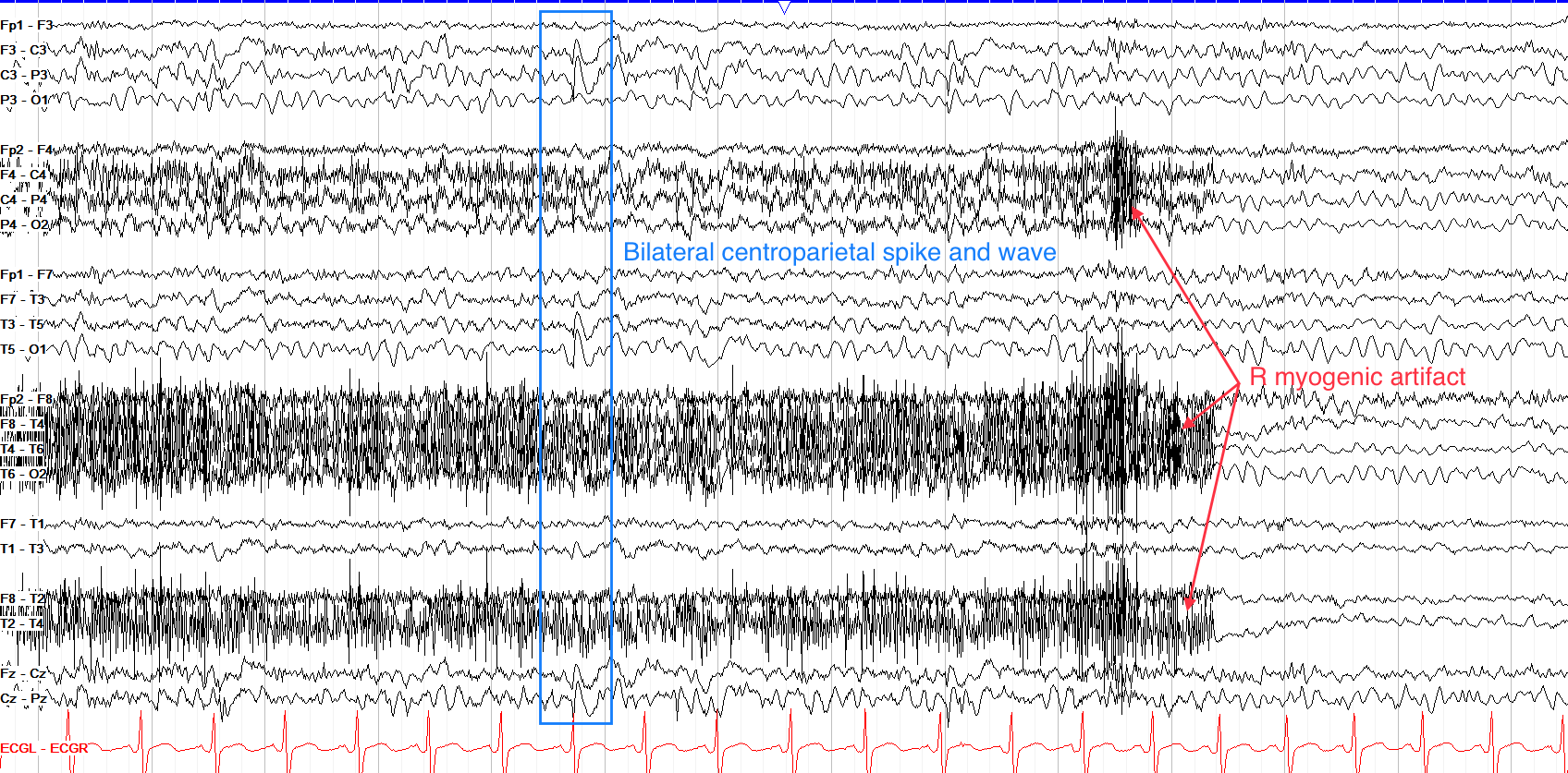 Bilateral centroparietal spike and wave annotations on