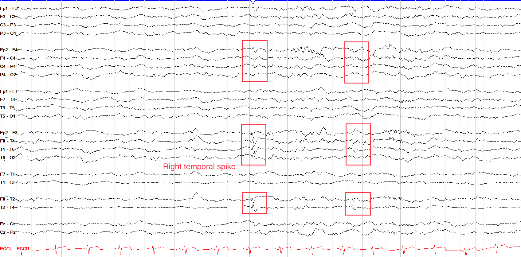 Right temporal spike annotations on