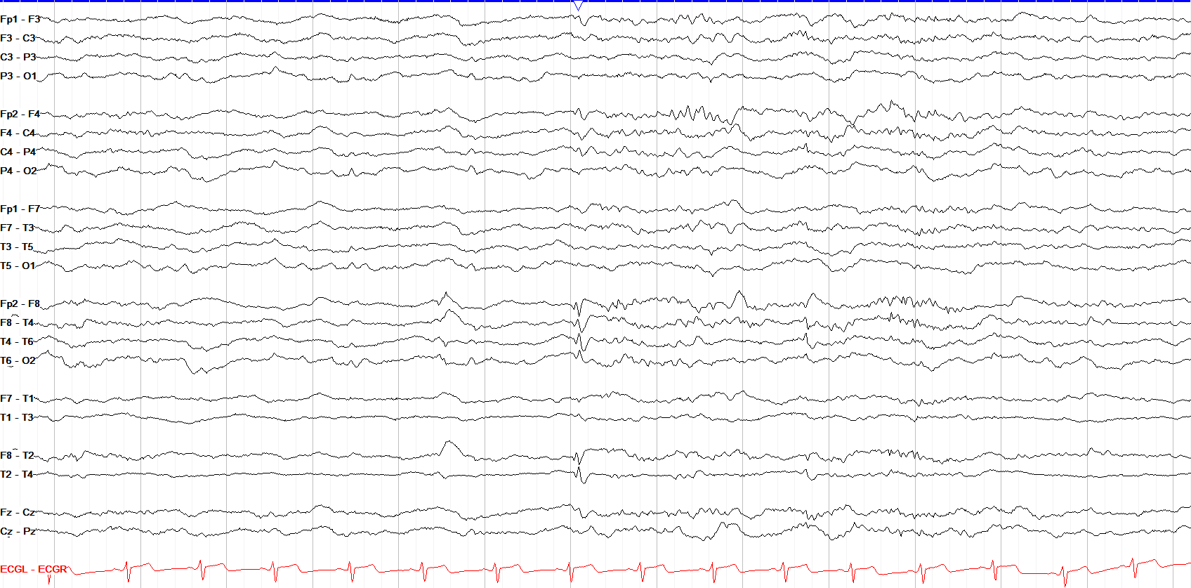 Right temporal spike annotations off