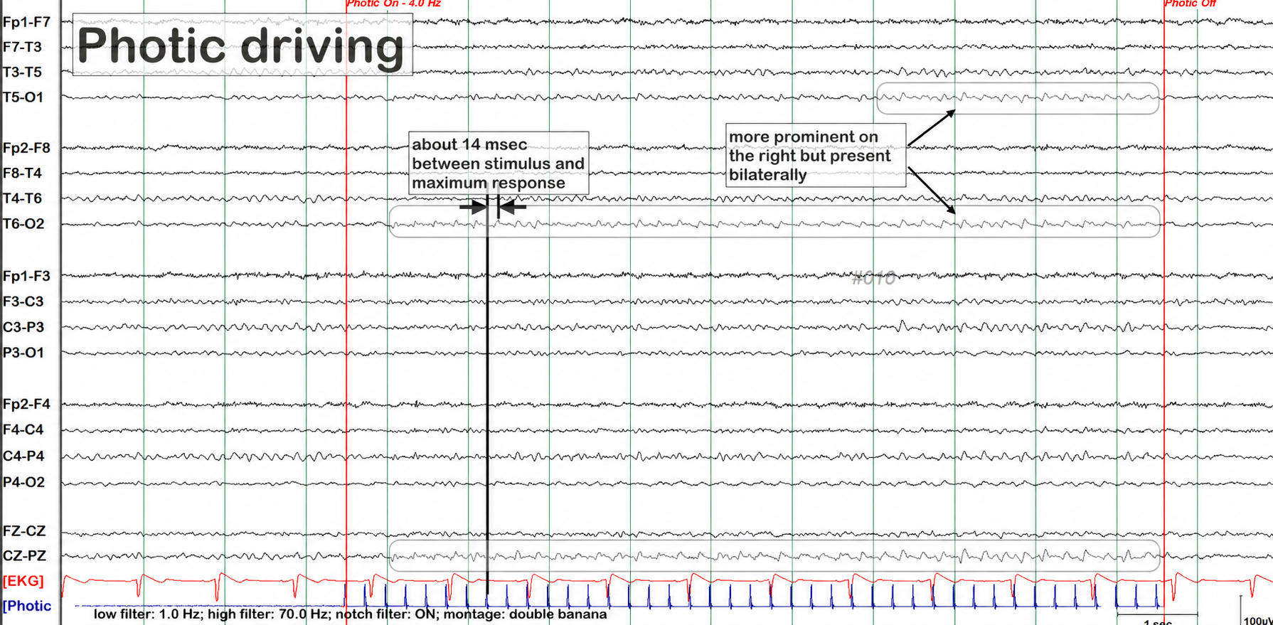 Photic driving example 1 annotations on