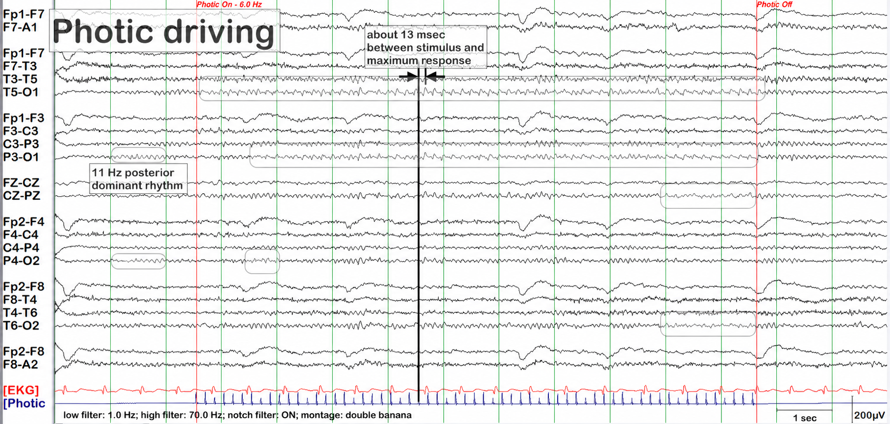 Photic driving example 2 annotations on