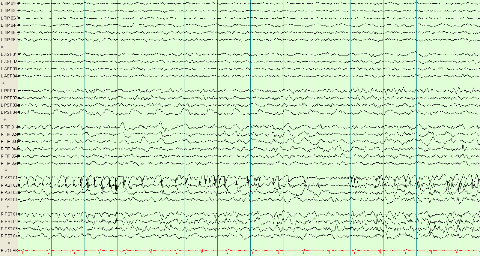 Хурц долгион EEG тэмдэглэгээгүй