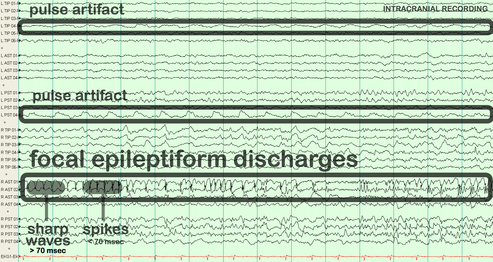 Хурц долгион EEG тэмдэглэгээтэй