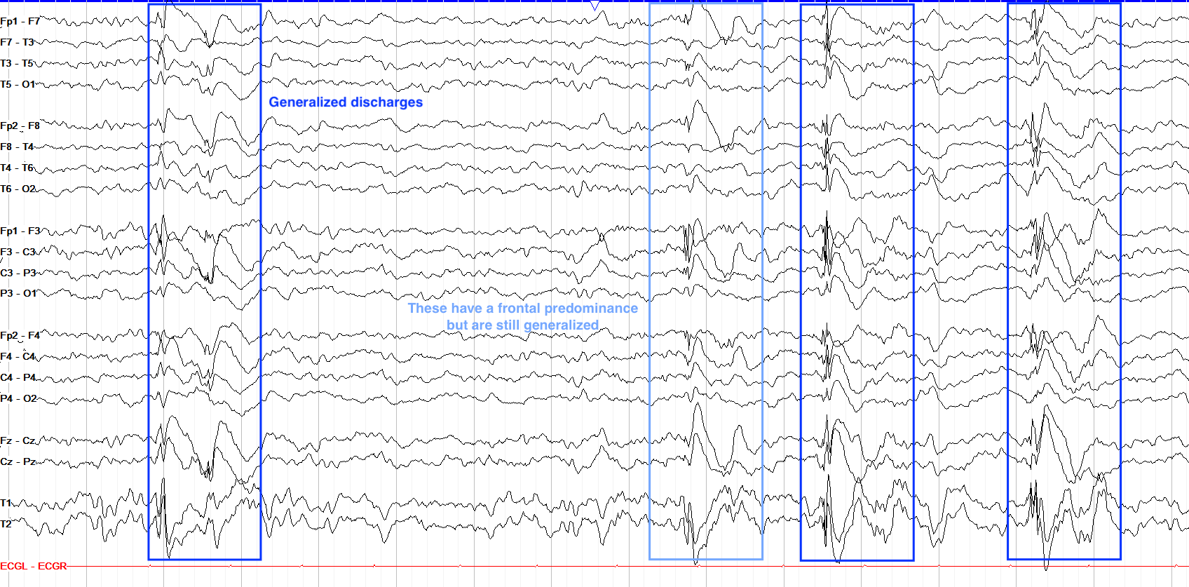 Spike example 3 annotations on