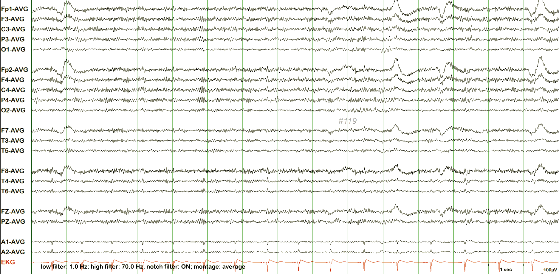 ECG ба лугшилтын артефакт хичээл, жишээ 1 — тэмдэглэгээгүй