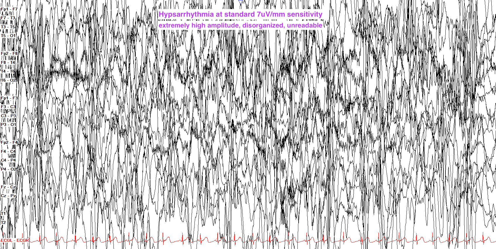 IESS EEG жишээ 1 — тэмдэглэгээгүй