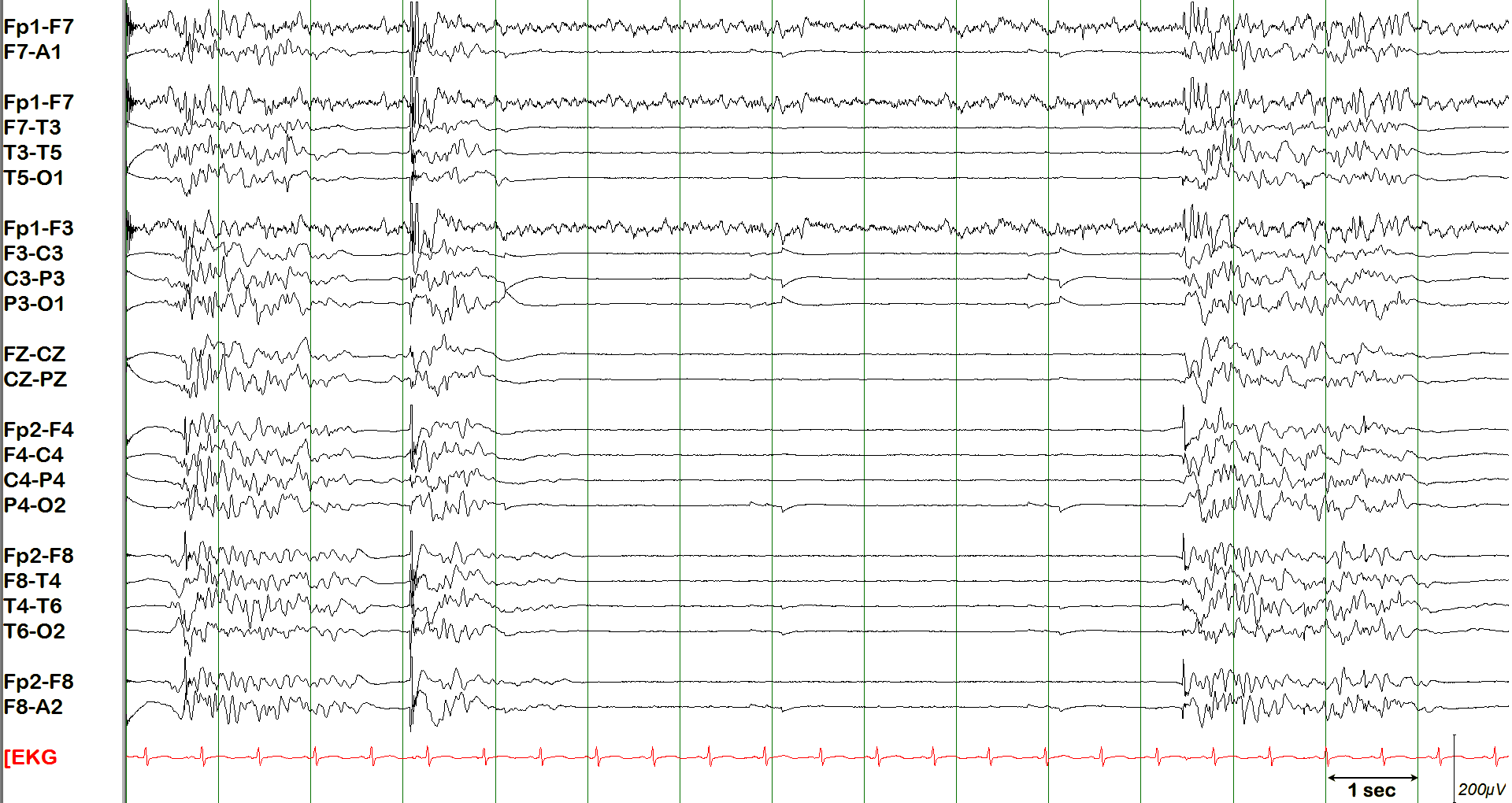 Burst suppression EEG example without annotation