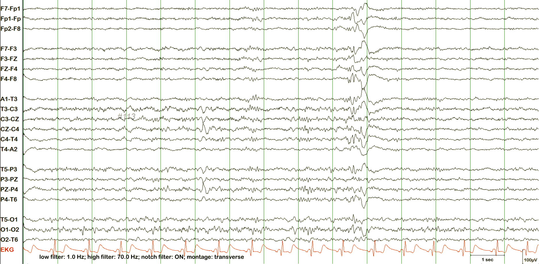 N2 sleep EEG example 1