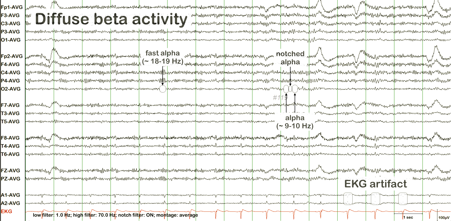 ECG ба лугшилтын артефакт хичээл, жишээ 1 — тэмдэглэгээтэй
