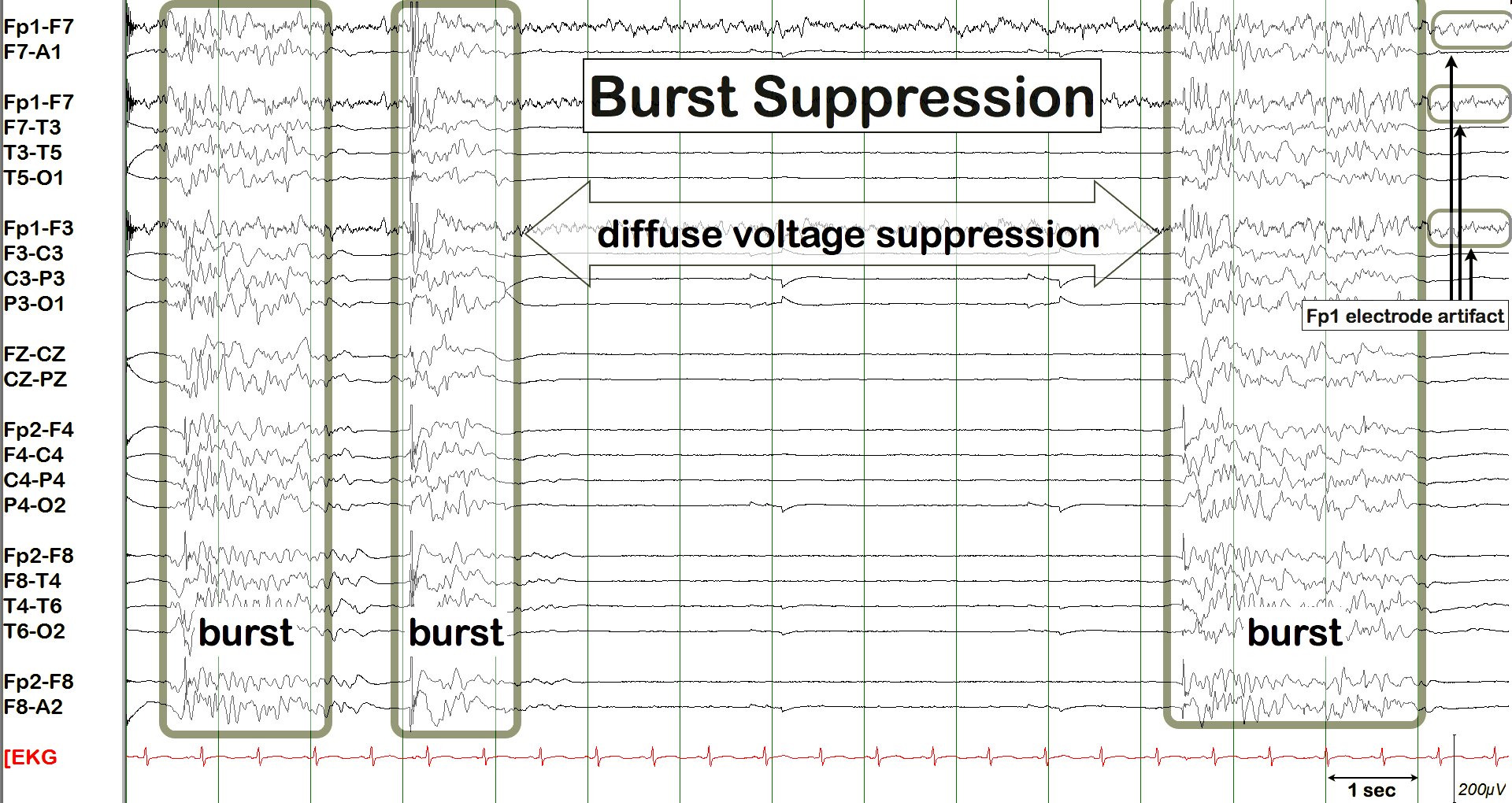 Burst suppression EEG example with annotated bursts and suppression