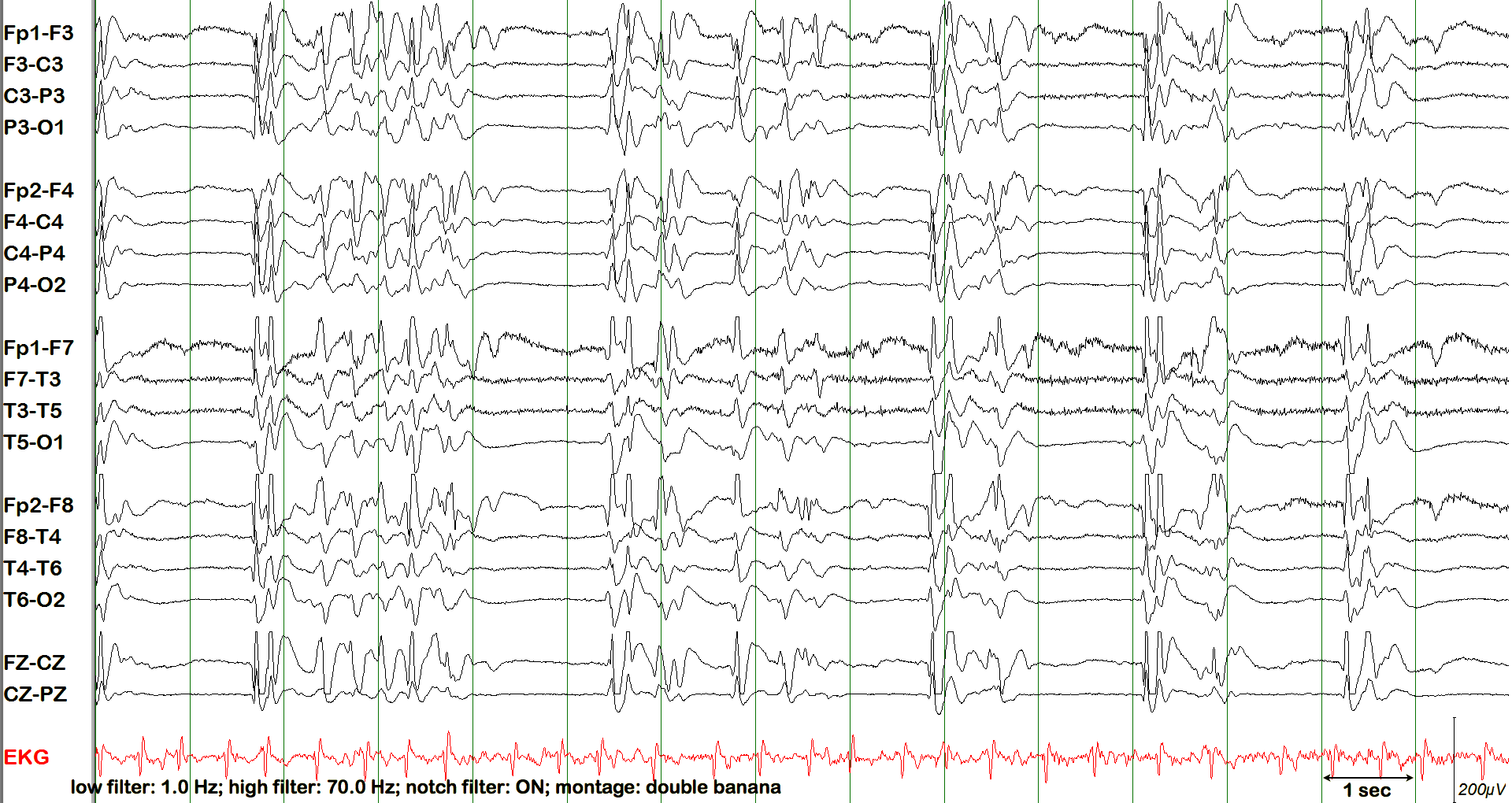 Repeated burst suppression pattern without annotation