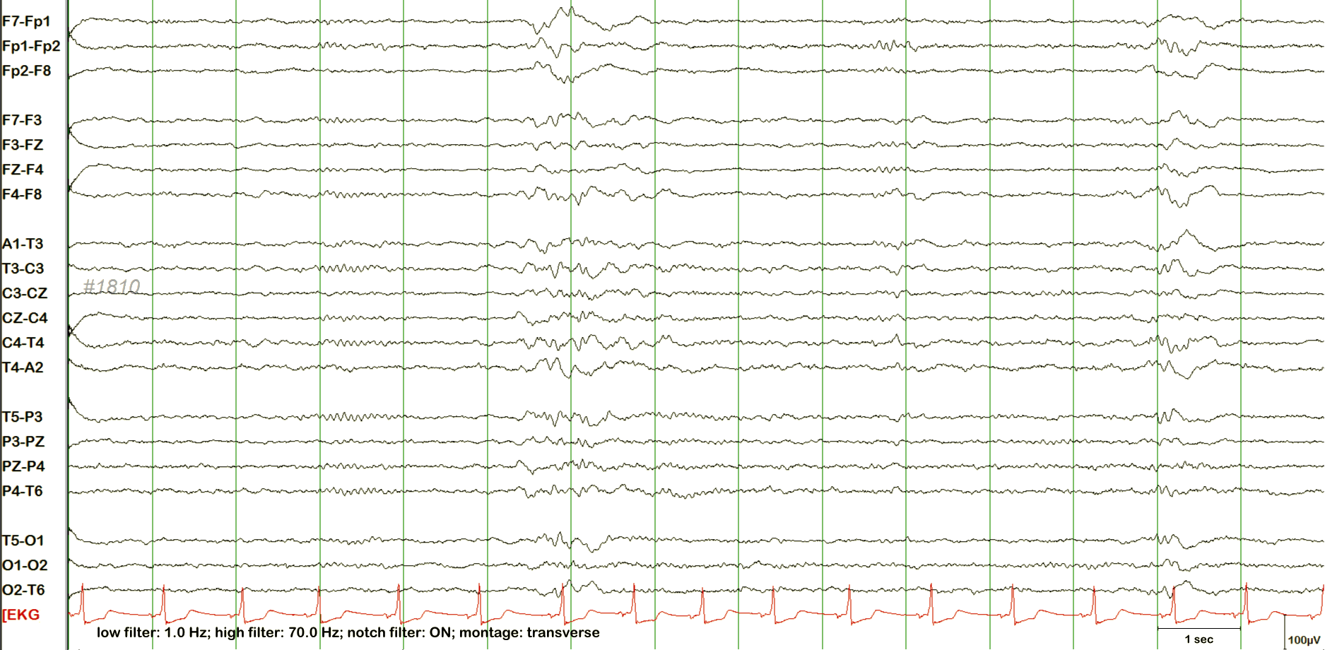 N2 sleep EEG example 2