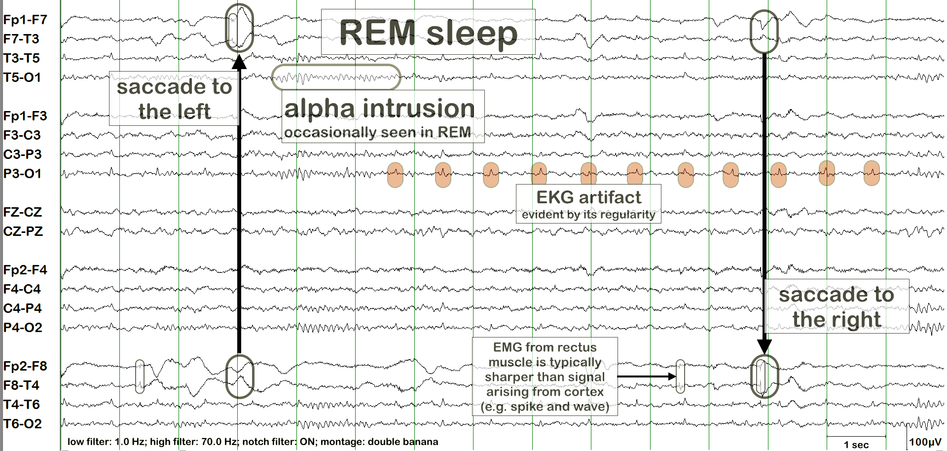 ECG ба лугшилтын артефакт хичээл, жишээ 2 — тэмдэглэгээтэй