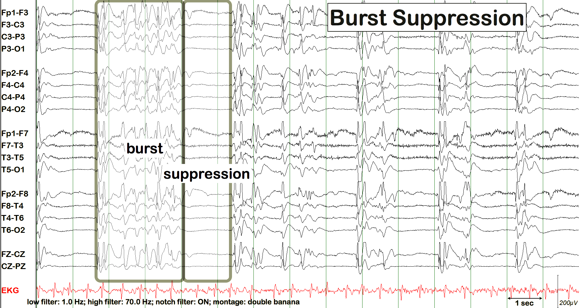 Repeated burst suppression EEG with burst and suppression labels