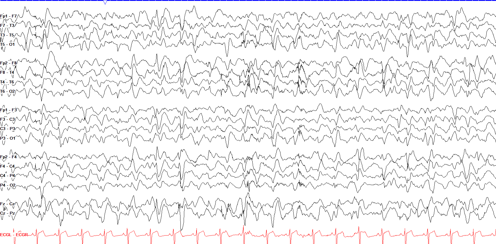 Lennox-Gastaut syndrome EEG жишээ 1 тэмдэглэгээгүй