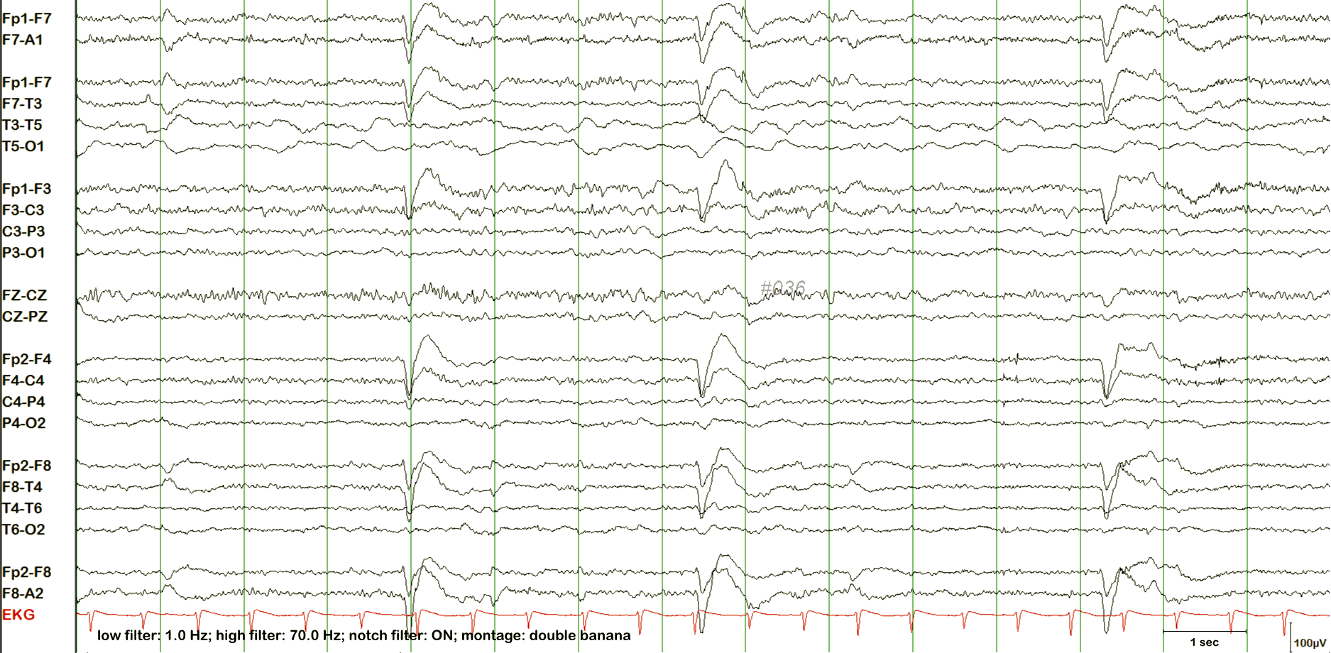 ECG ба лугшилтын артефакт хичээл, жишээ 3 — тэмдэглэгээгүй