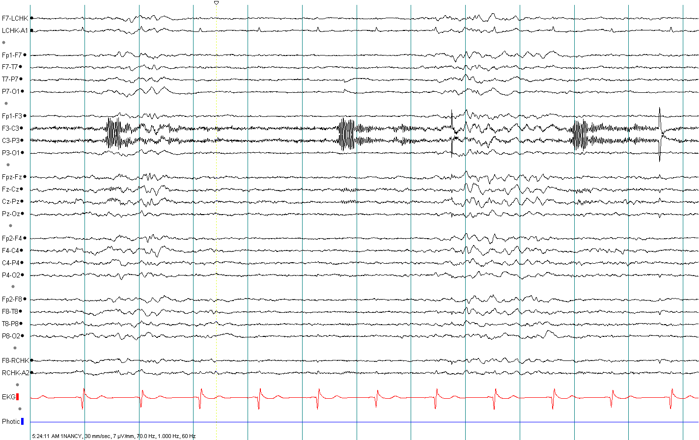 Burst suppression EEG with respirator artifact without annotation