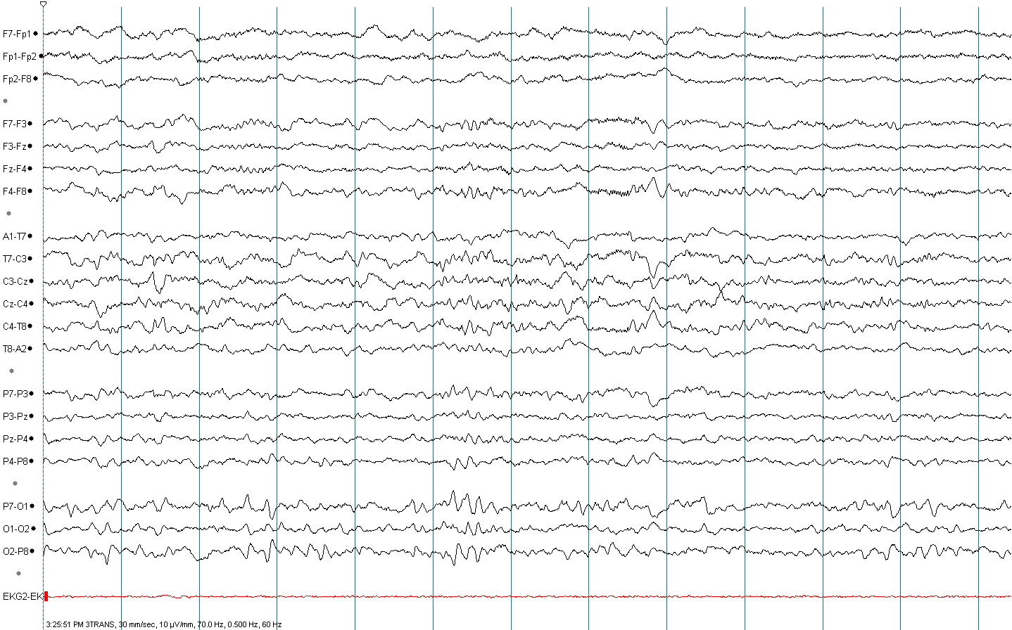 N2 sleep EEG example 3