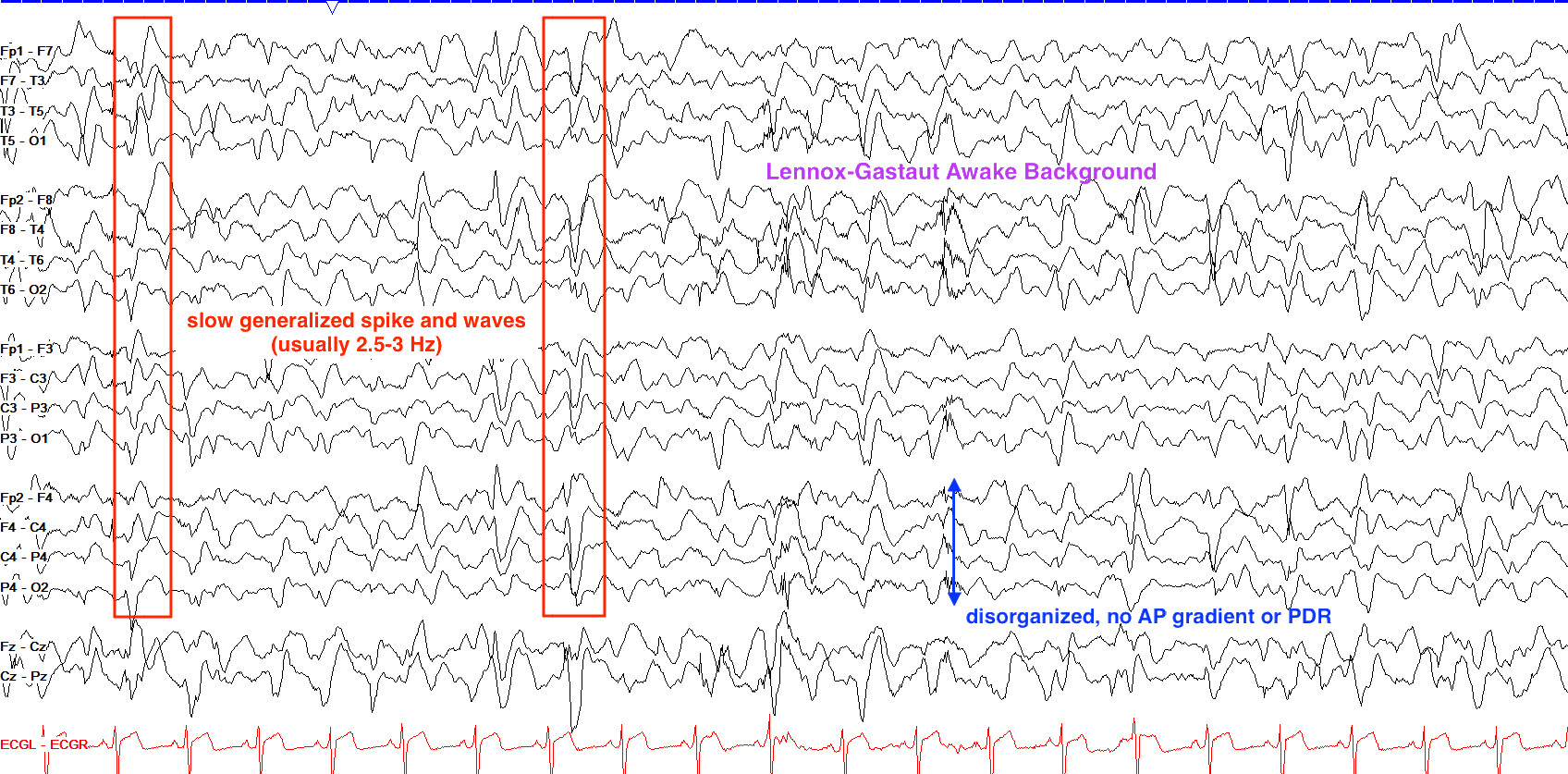 Lennox-Gastaut syndrome EEG жишээ 1 тэмдэглэгээтэй