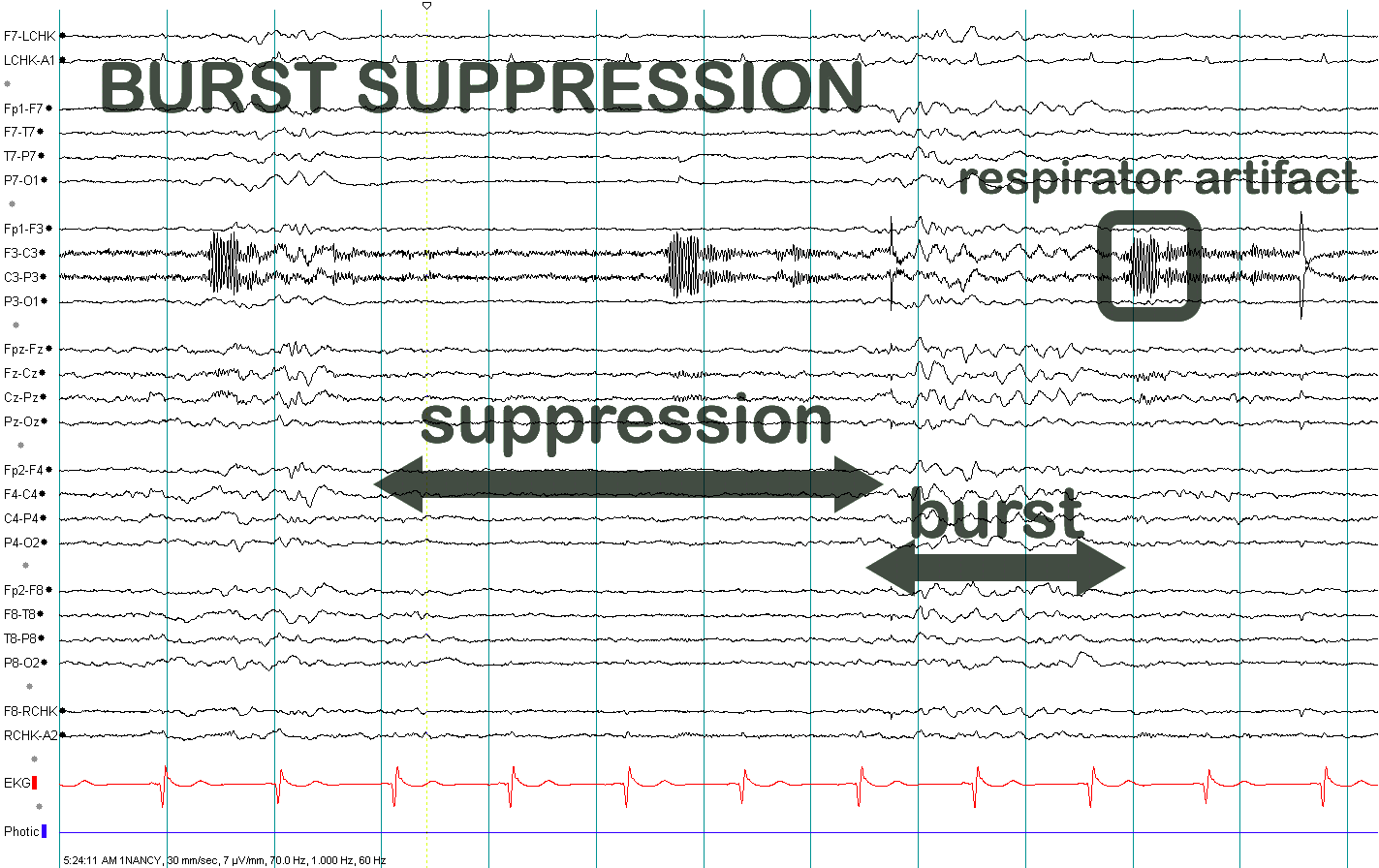 Burst suppression EEG with annotated suppression burst and respirator artifact