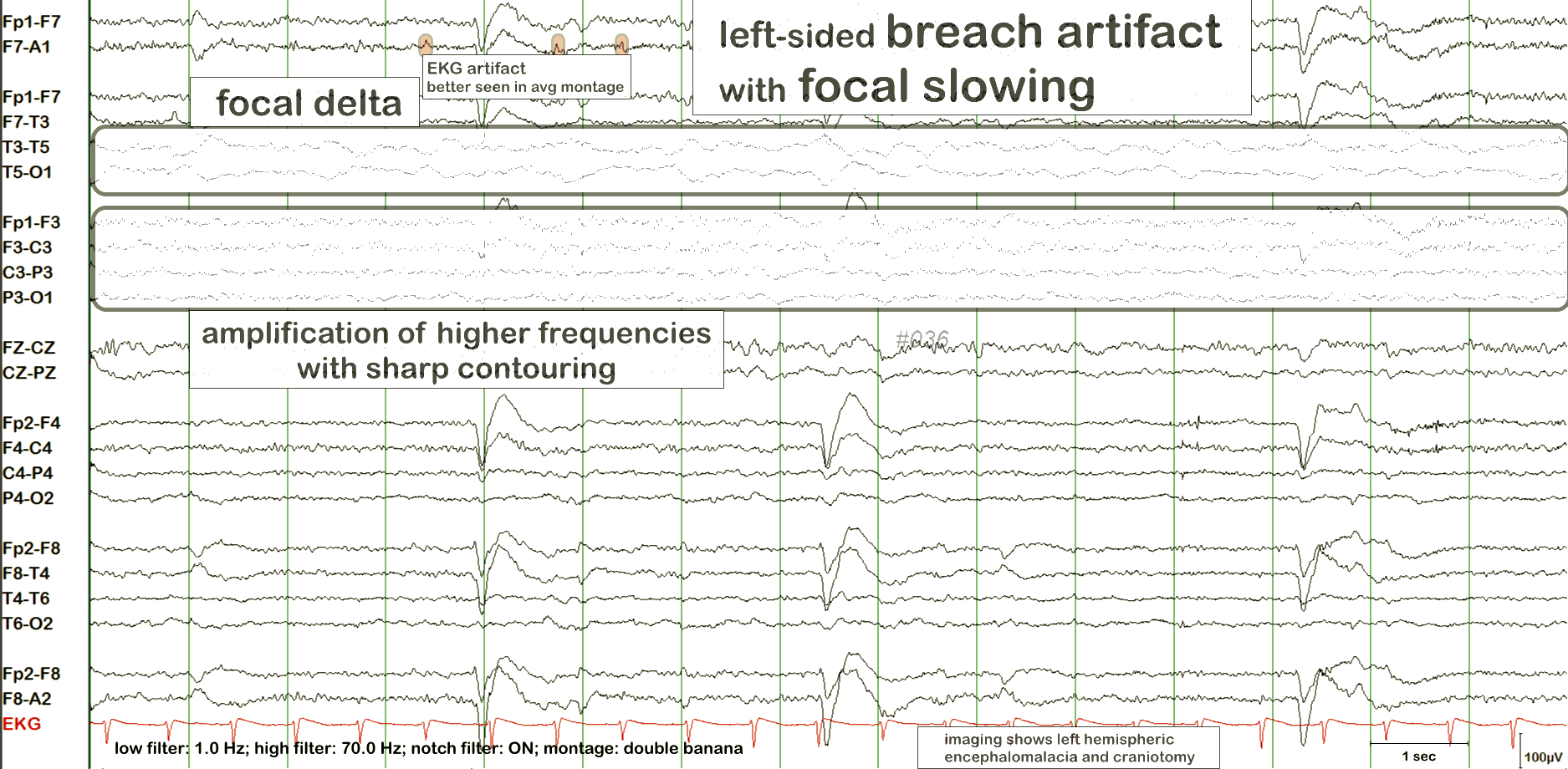 ECG ба лугшилтын артефакт хичээл, жишээ 3 — тэмдэглэгээтэй