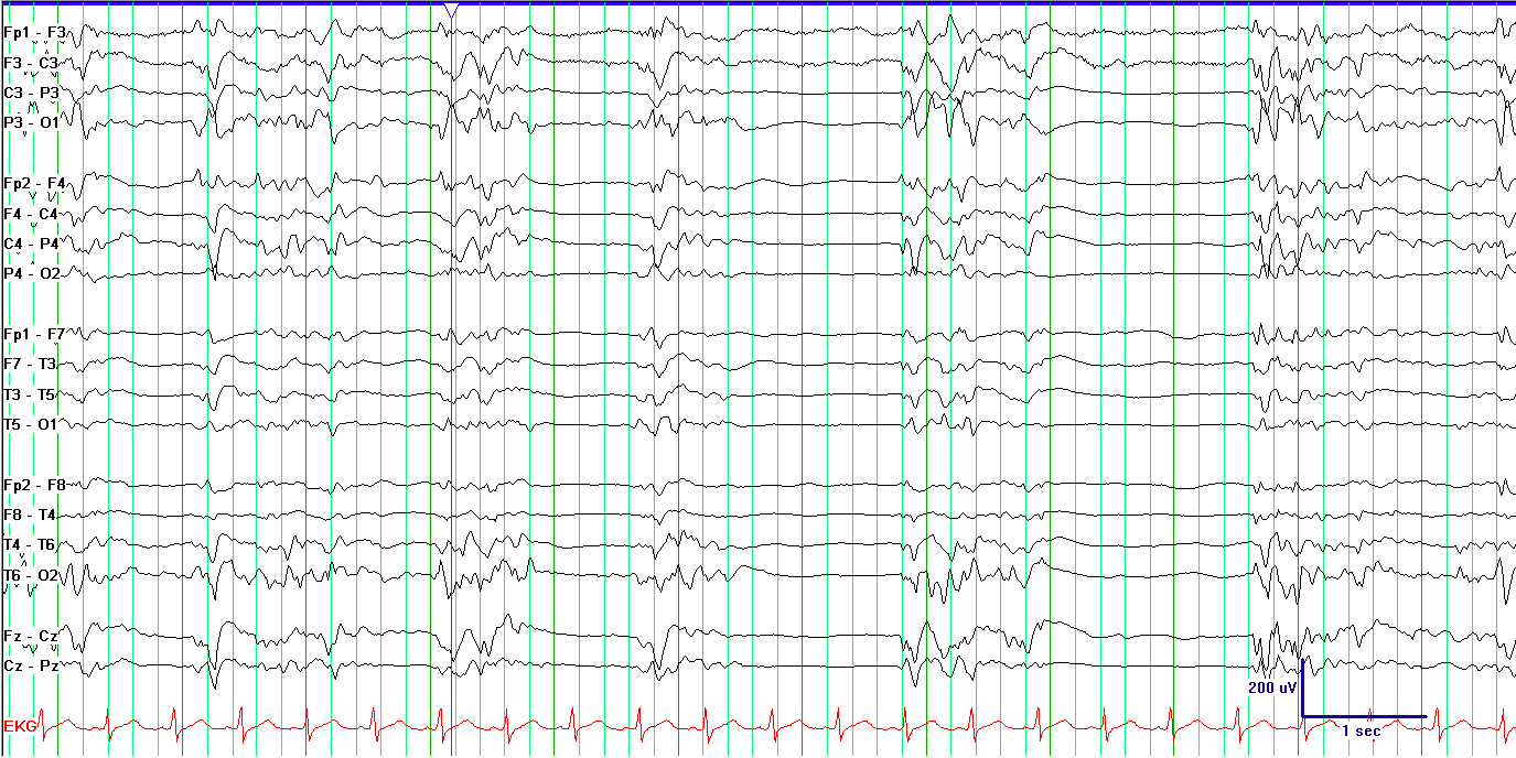 Burst suppression EEG example without labels