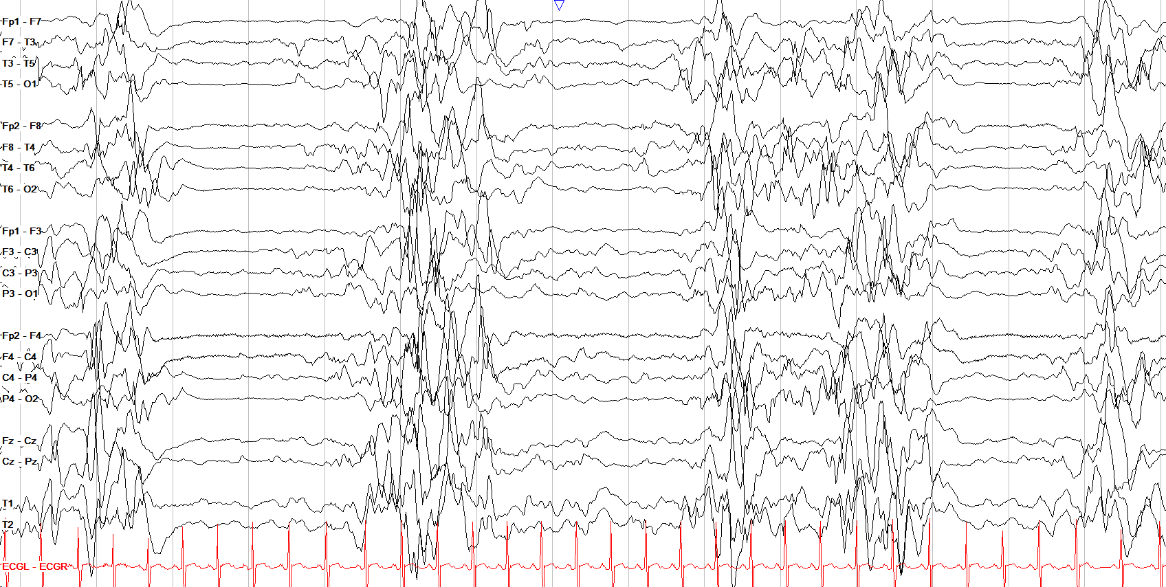 Ohtahara syndrome EEG жишээ 1 тэмдэглэгээгүй
