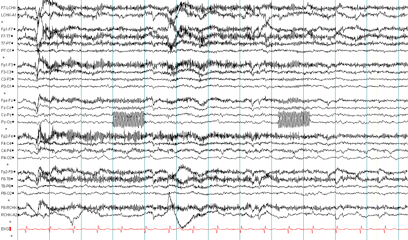 ECG ба лугшилтын артефакт хичээл, жишээ 4 — тэмдэглэгээгүй