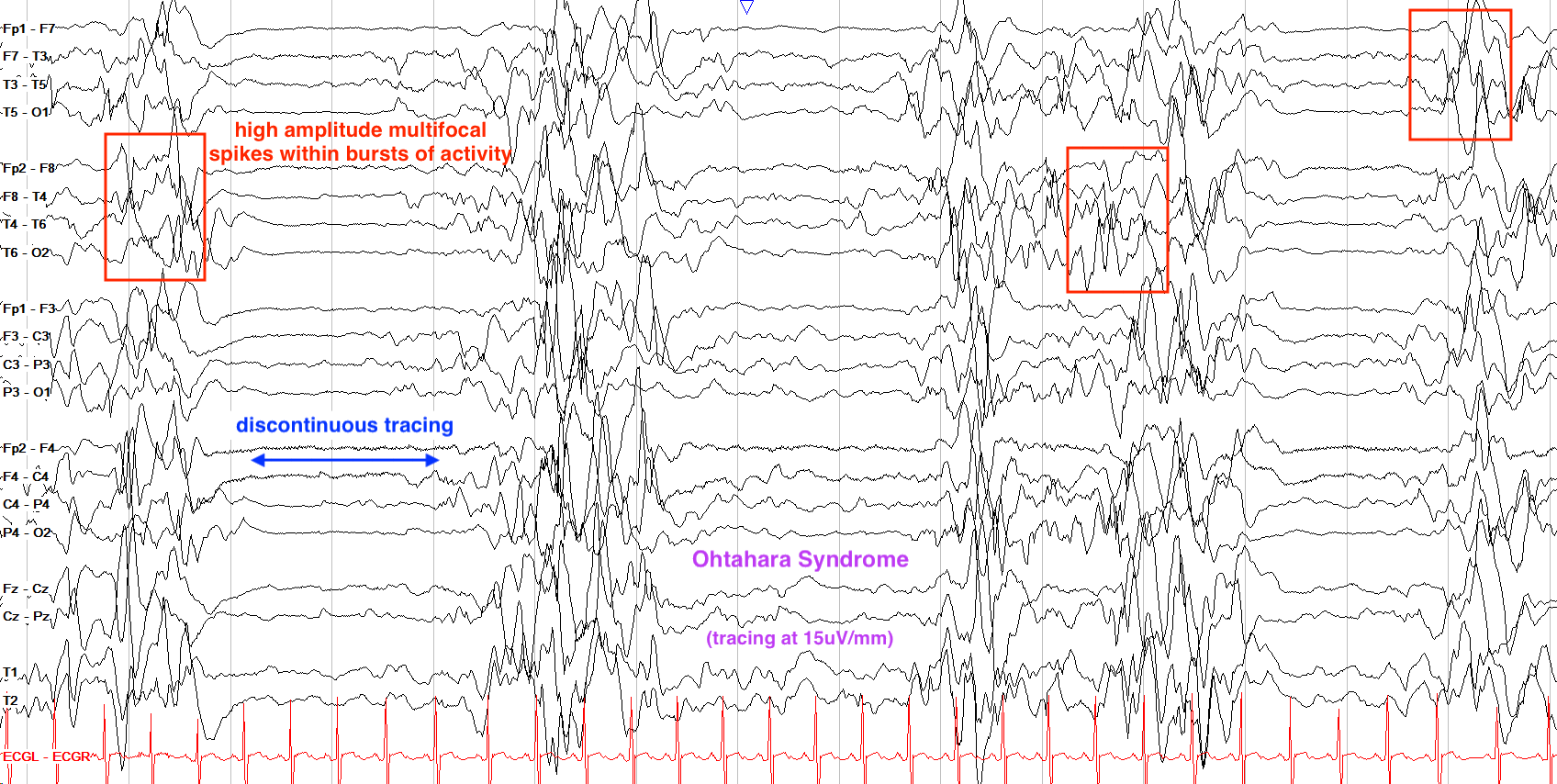 Ohtahara syndrome EEG жишээ 1 тэмдэглэгээтэй