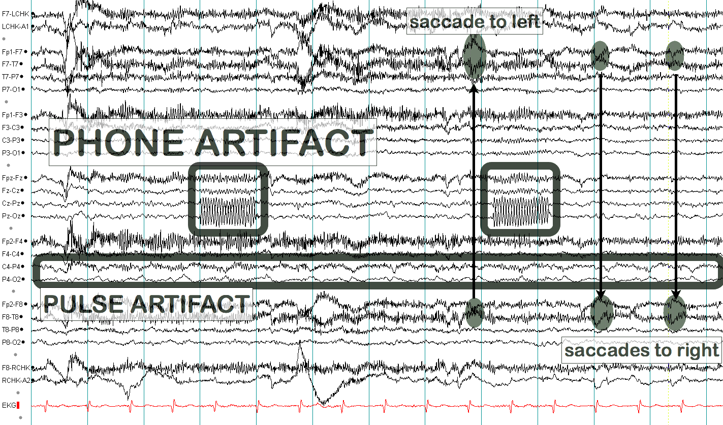 ECG ба лугшилтын артефакт хичээл, жишээ 4 — тэмдэглэгээтэй