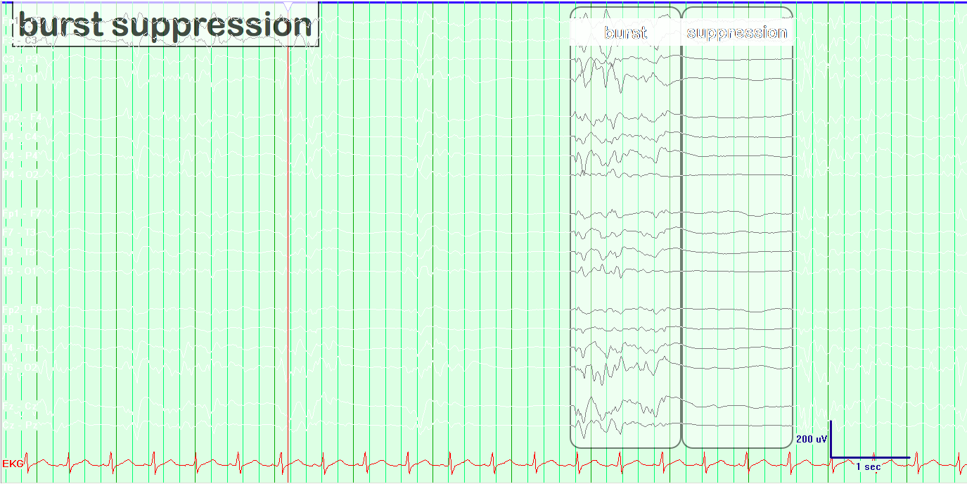 Burst suppression EEG example annotated with burst and suppression