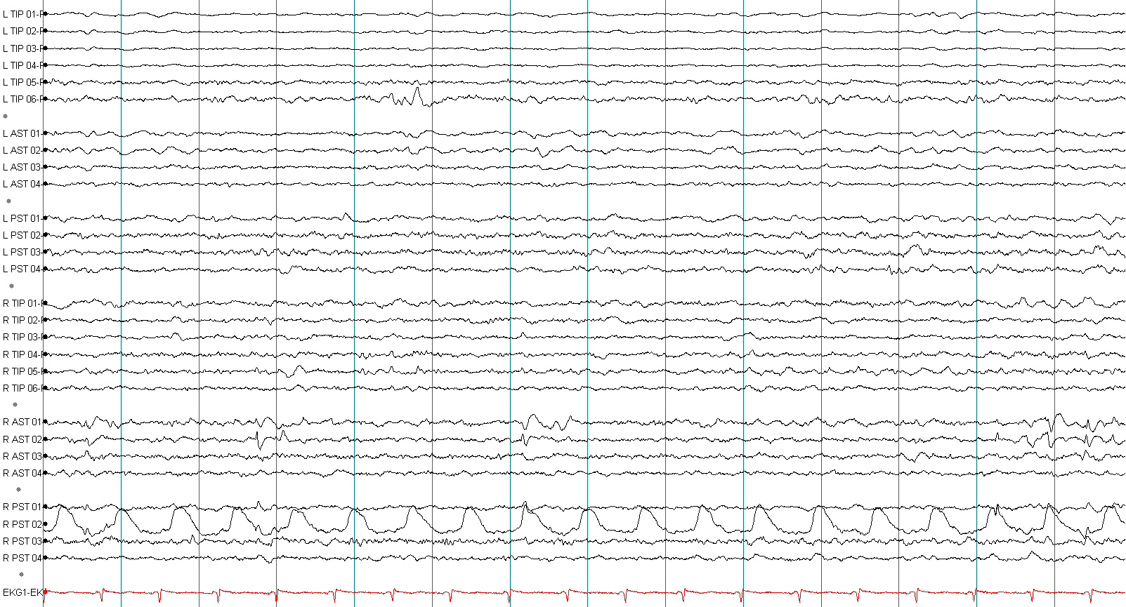 ECG ба лугшилтын артефакт хичээл, жишээ 5 — тэмдэглэгээтэй