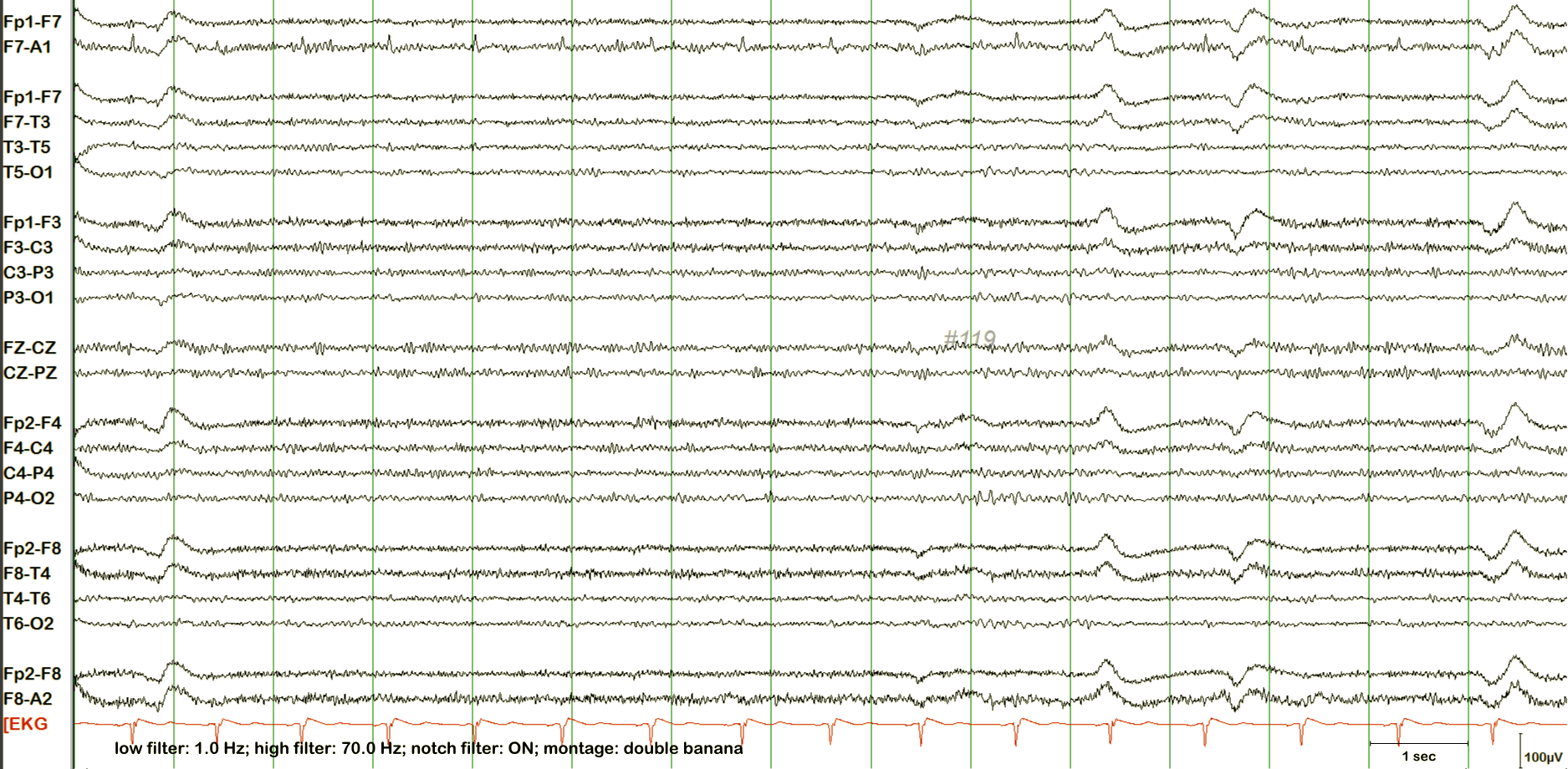 Excessive fast activity EEG without annotation