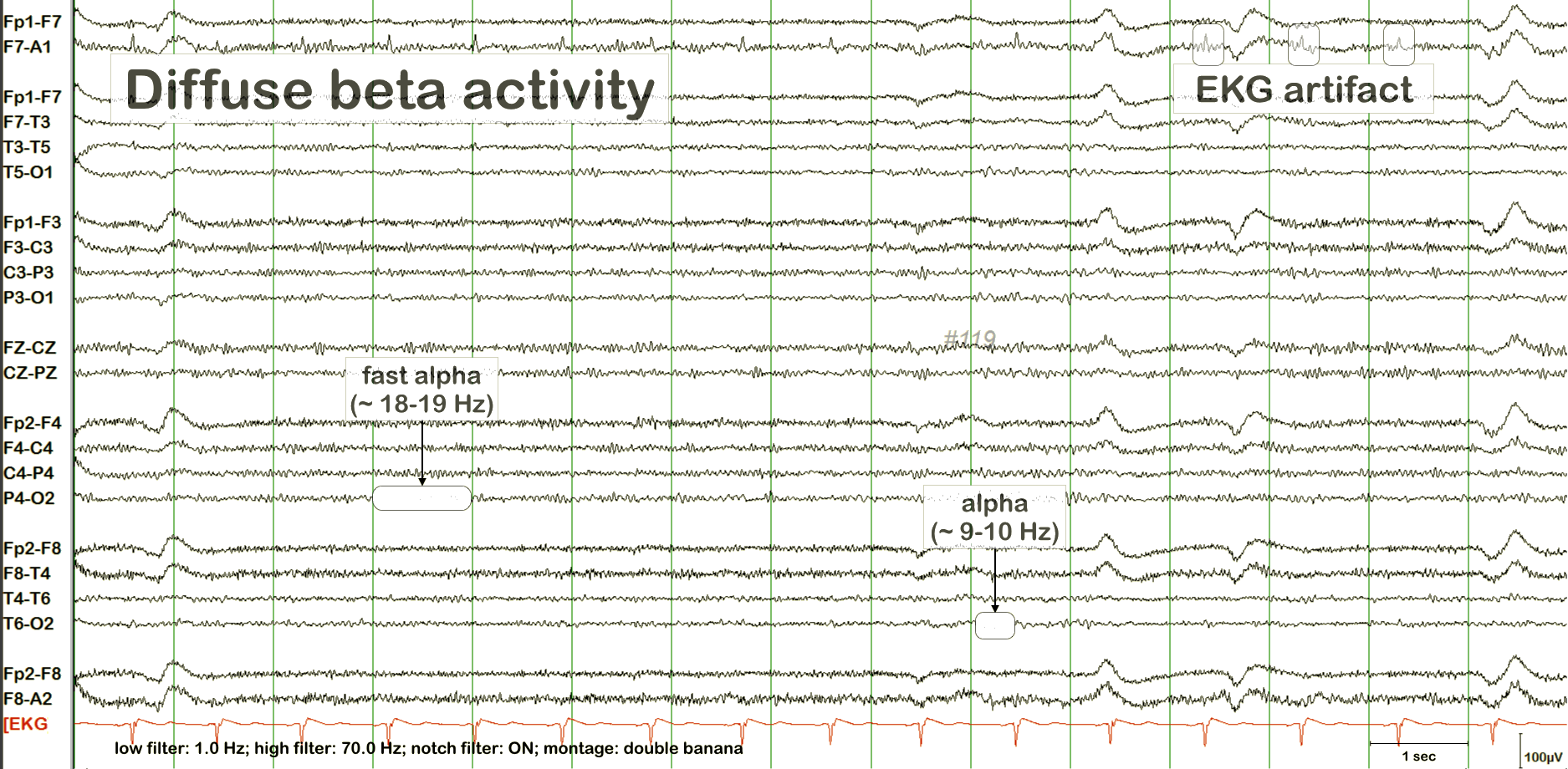 Excessive fast activity EEG with annotation