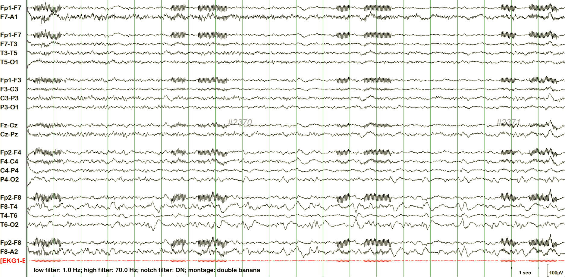 Breach effect EEG example 1 without annotation