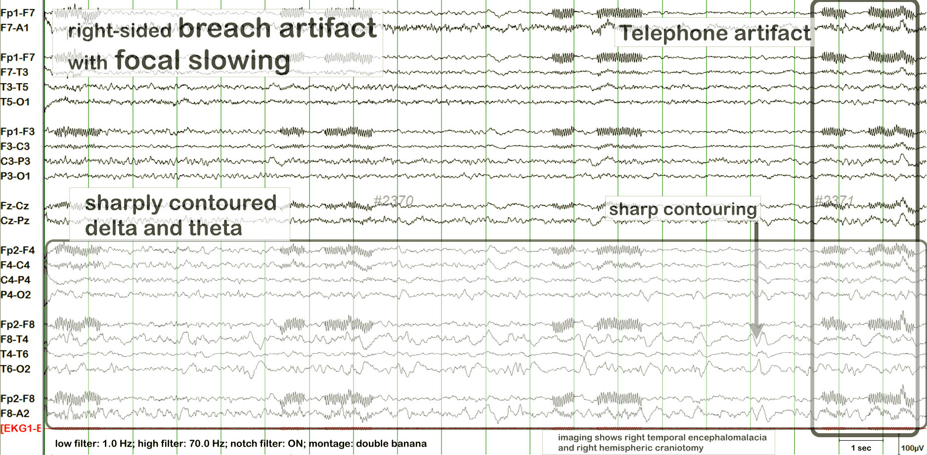 Breach effect EEG example 1 with annotation