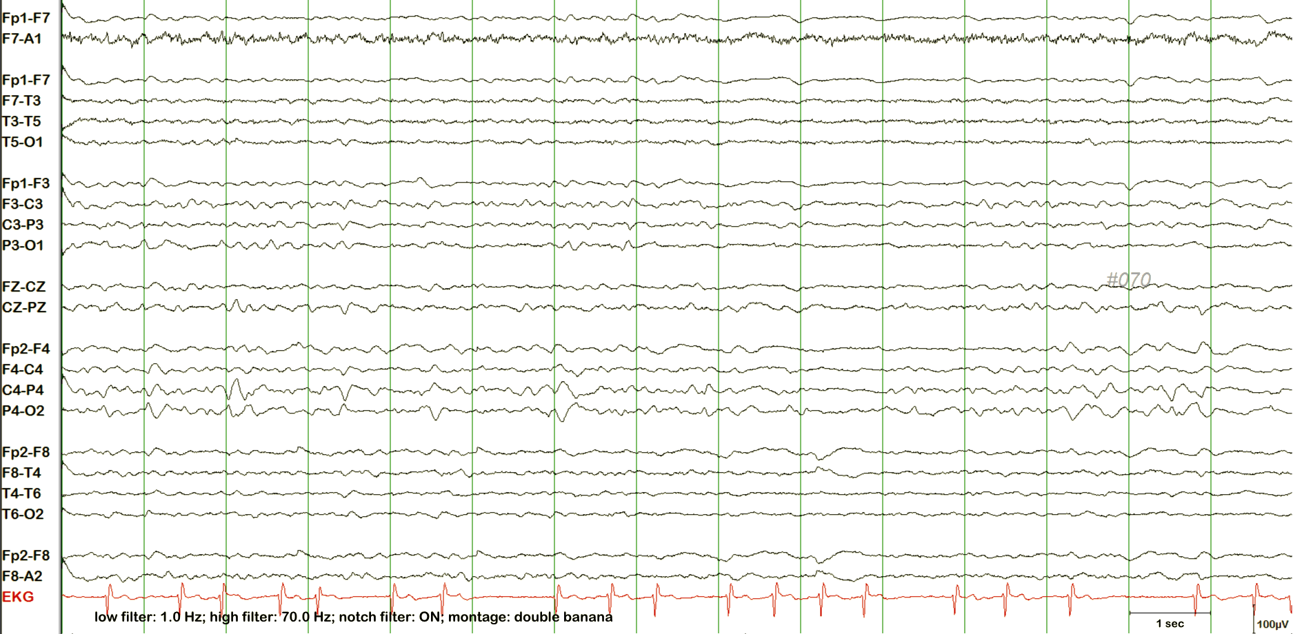 Breach effect EEG example 2 without annotation