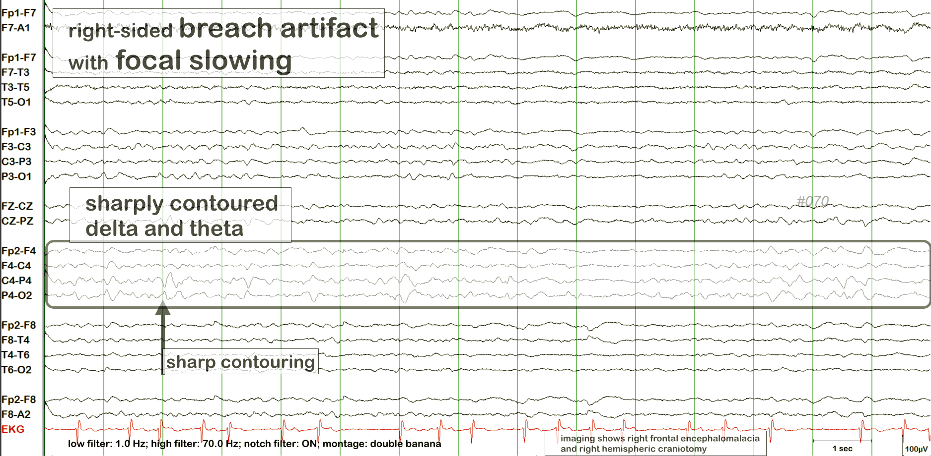 Breach effect EEG example 2 with annotation