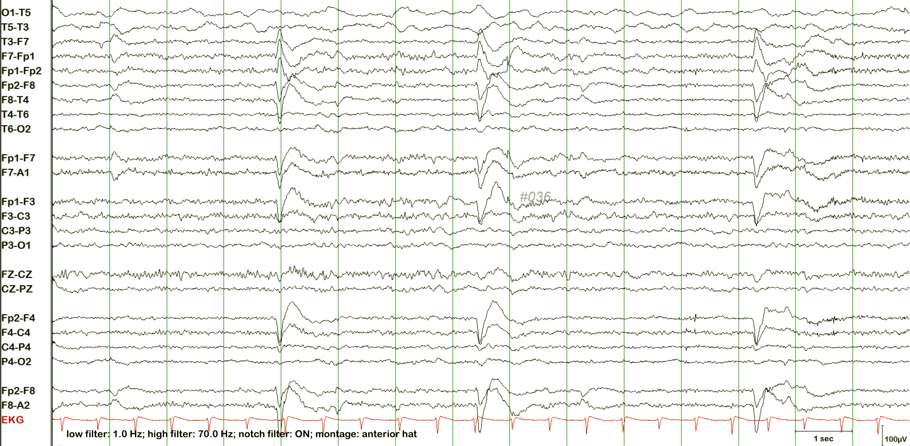 Breach rhythm EEG example 3 without annotation