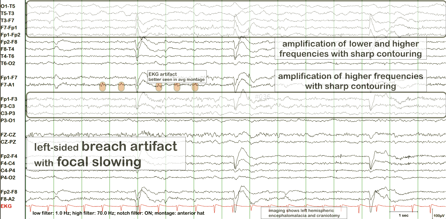 Breach rhythm EEG example 3 with annotation