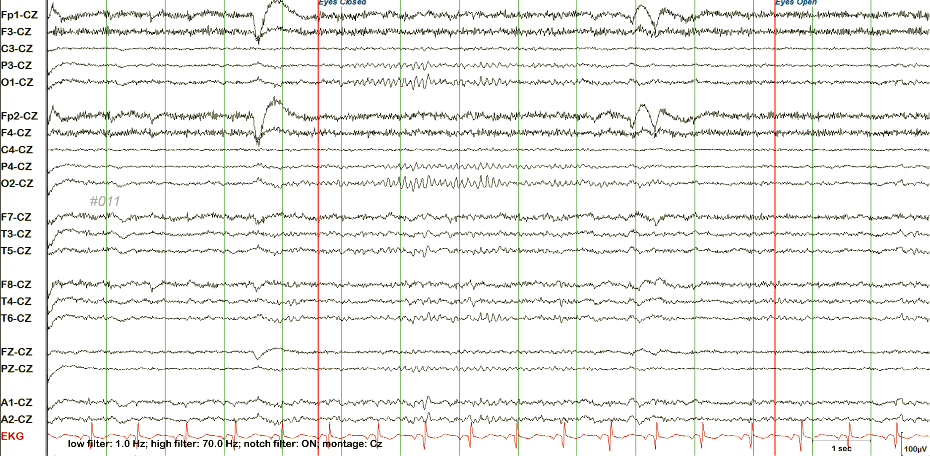 Alpha squeak EEG example 1 without annotation