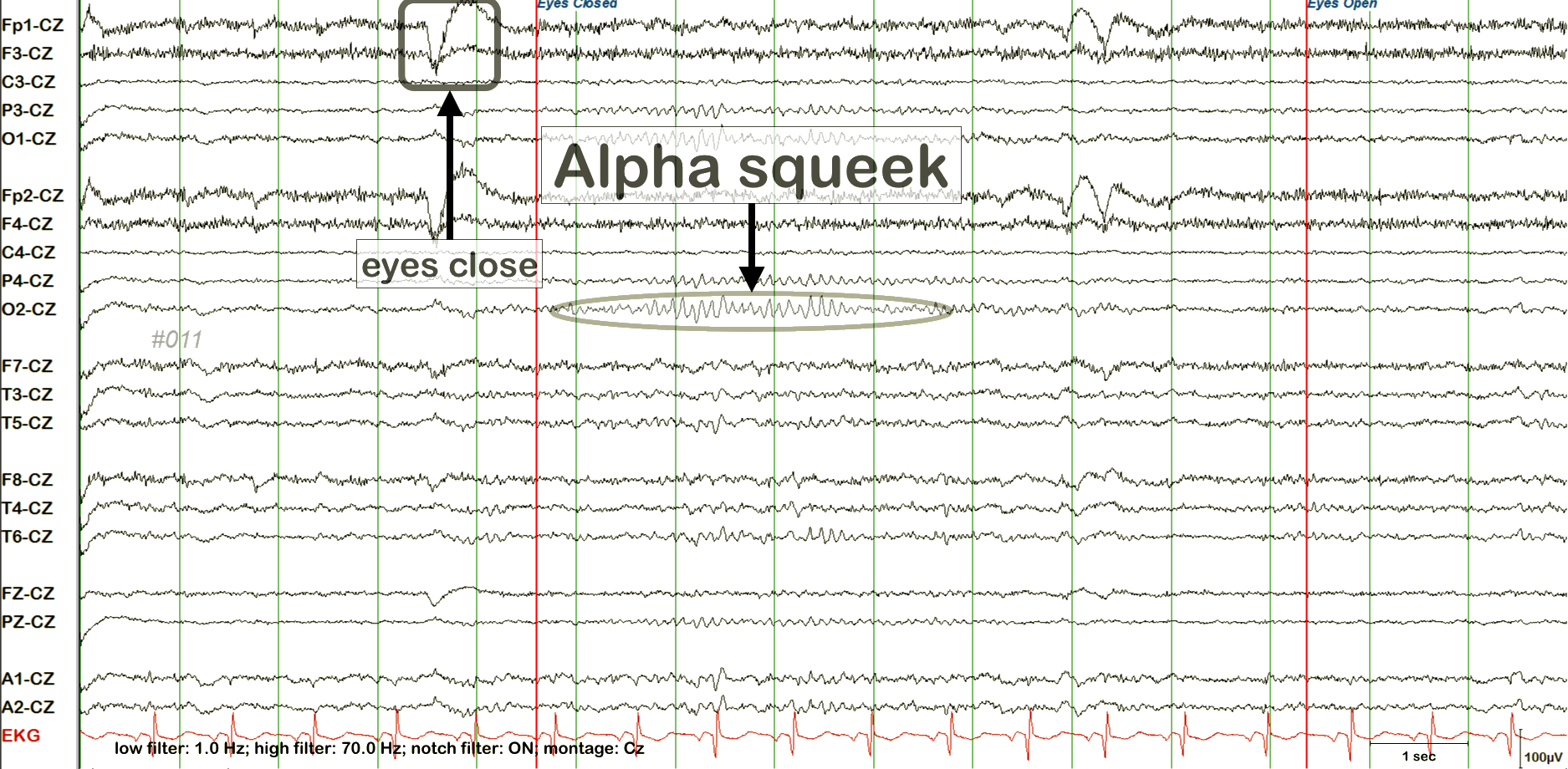Alpha squeak EEG example 1 with annotation