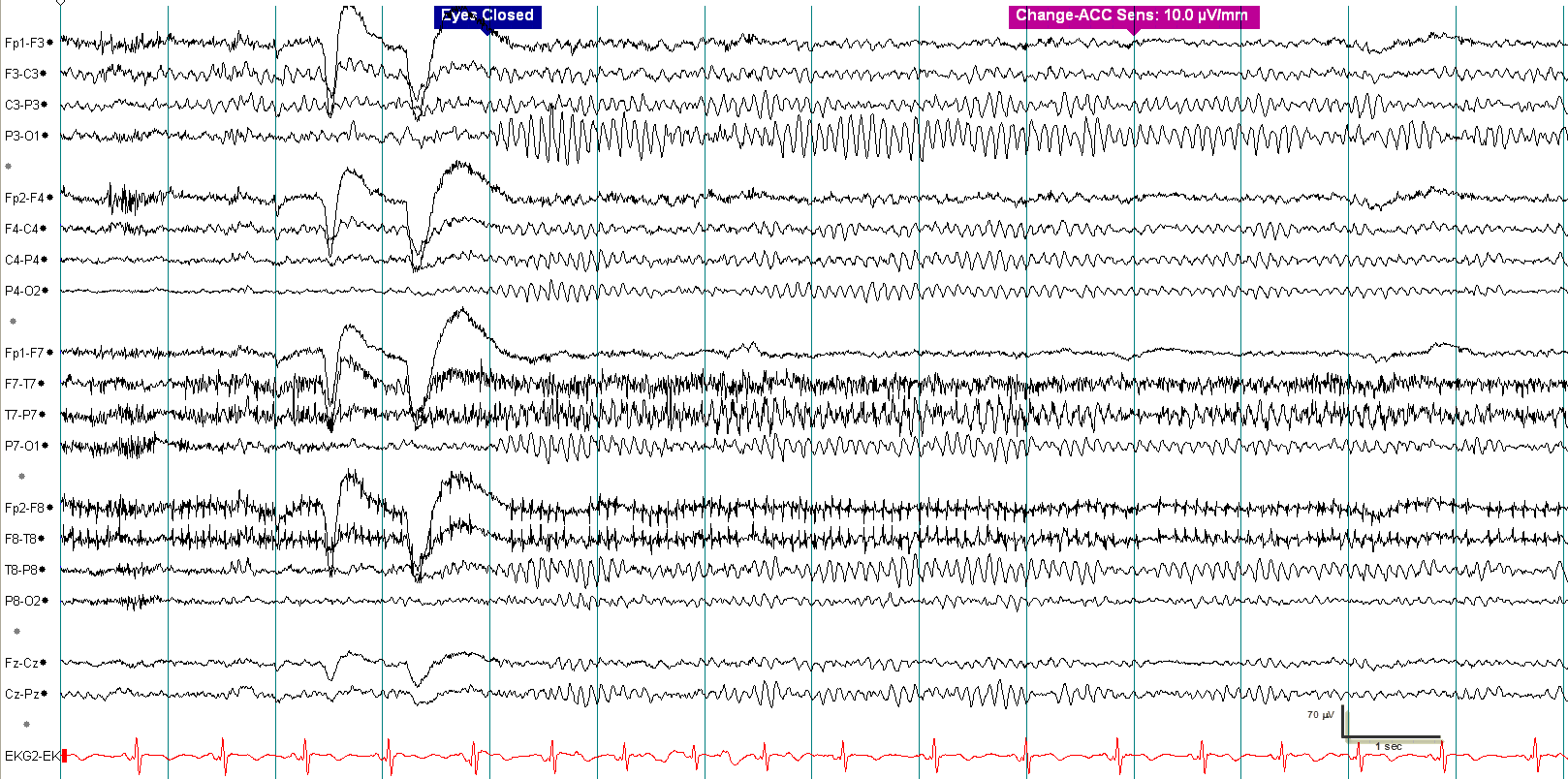 Alpha squeak EEG example 2 without annotation