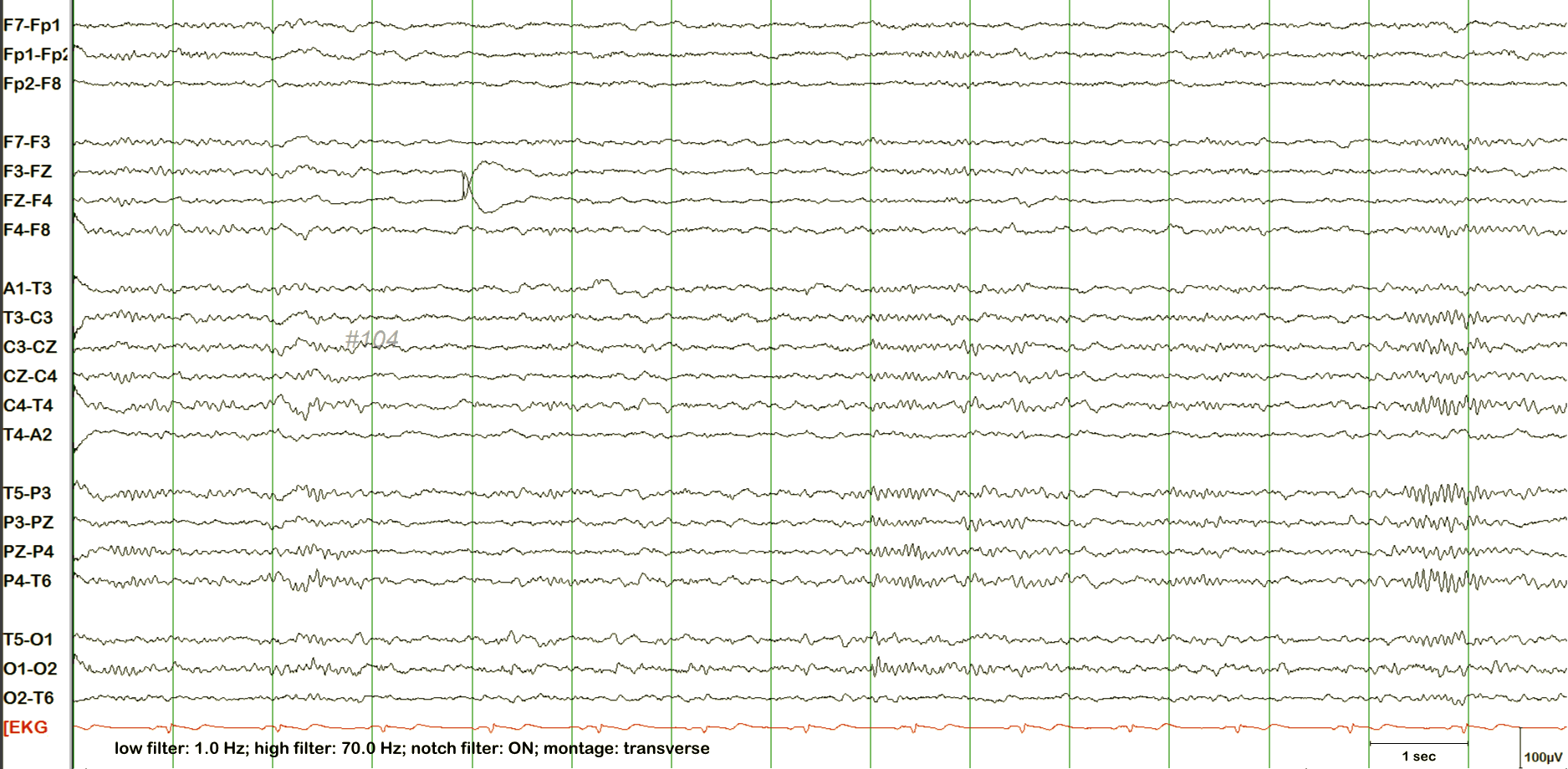 POSTS EEG example 2