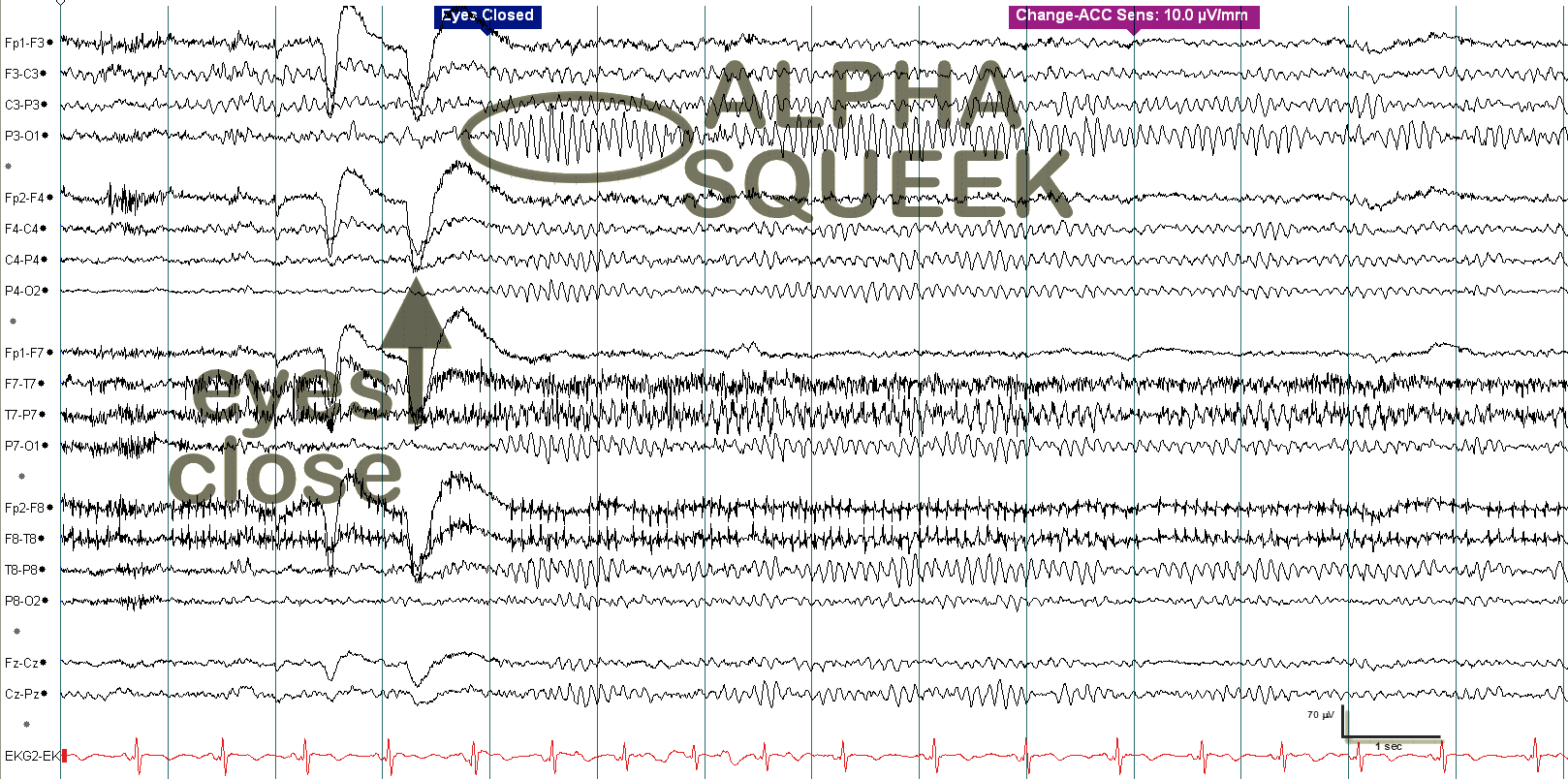 Alpha squeak EEG example 2 with annotation