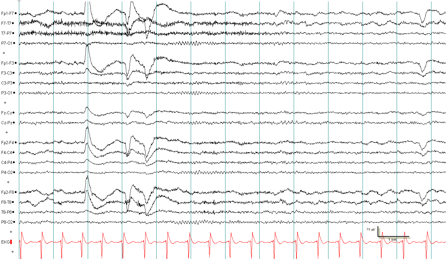 Alpha squeak EEG example 3 without annotation