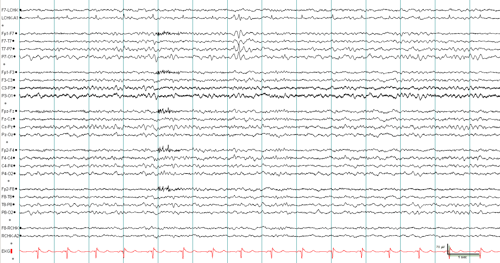 Wicket waves EEG example